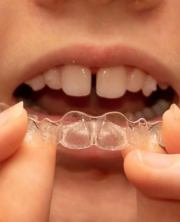 マウスピース型矯正装置