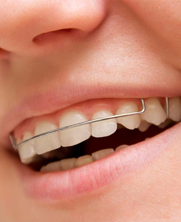 機能的矯正装置（バイオネーター・FKO）